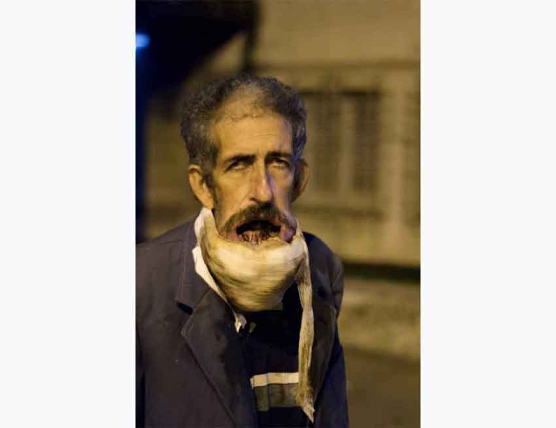 Hombre con gran tumor bucal. Foto: Claudio Fuentes Madan