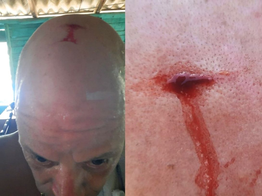 Herida en la cabeza del periodista independiente José Antonio López Piña, provocada por una golpiza propinada por las fuerzas represivas del cubano en Santiago de Cuba (julio de 2026).