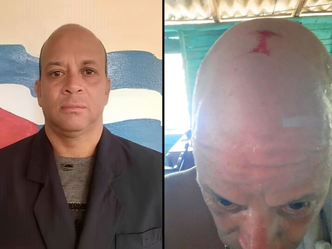 Periodista independiente cubano José Antonio López Piña y foto de la herida que provocó la golpiza propinada por la policía política cubana (julio de 2026).