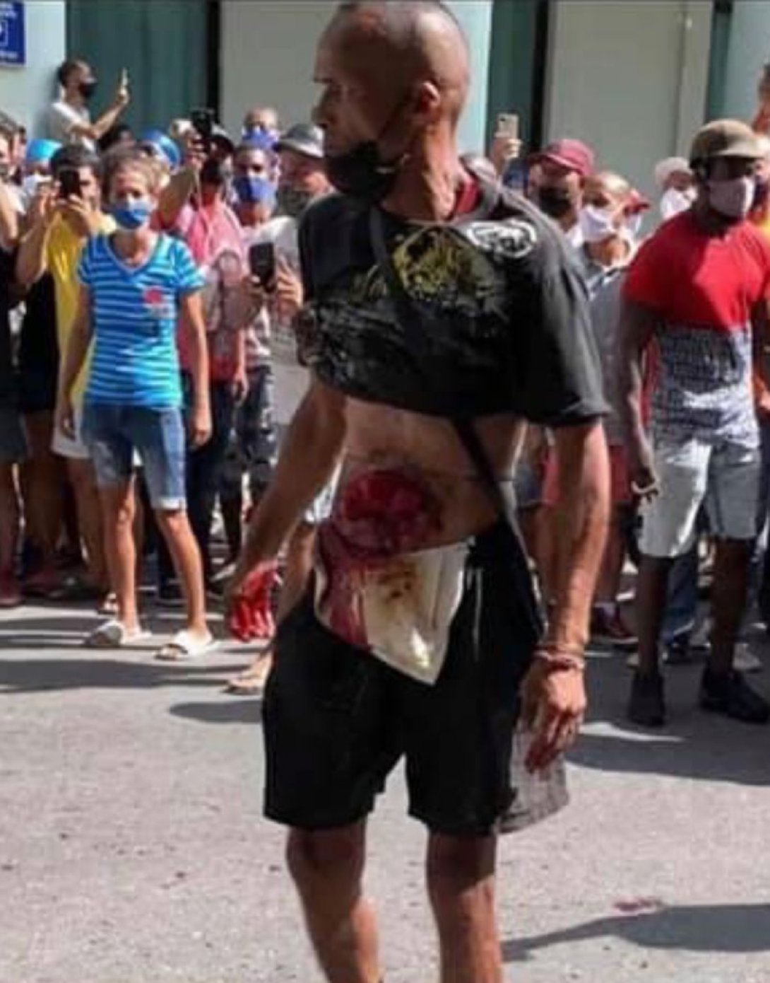 Un manifestante herido. Protestas en Cuba