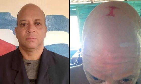 Periodista independiente cubano José Antonio López Piña y foto de la herida que provocó la golpiza propinada por la policía política cubana (julio de 2026).